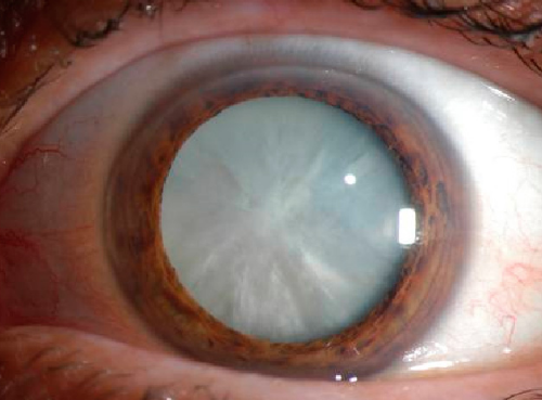 Лечение катаракты на дому